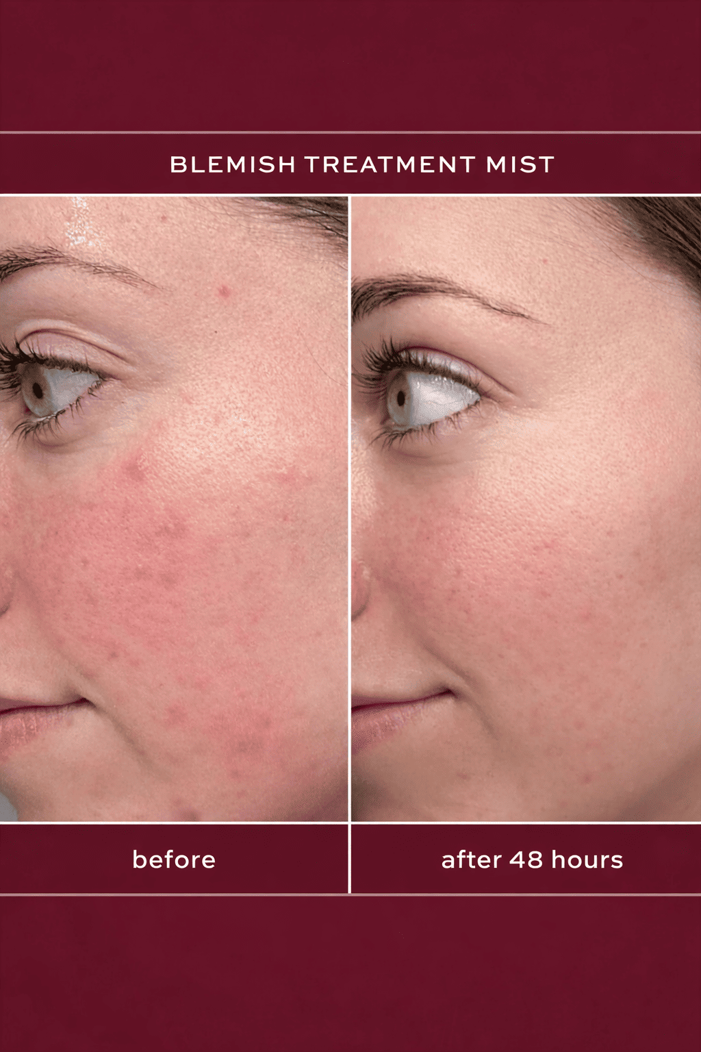 2% Salicylic Acid Acne Spray for Face & Body – BHA Clarifying Mist (3.3 oz)