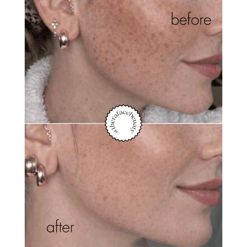 Before and after comparison of a woman's face with skin treatment results.
