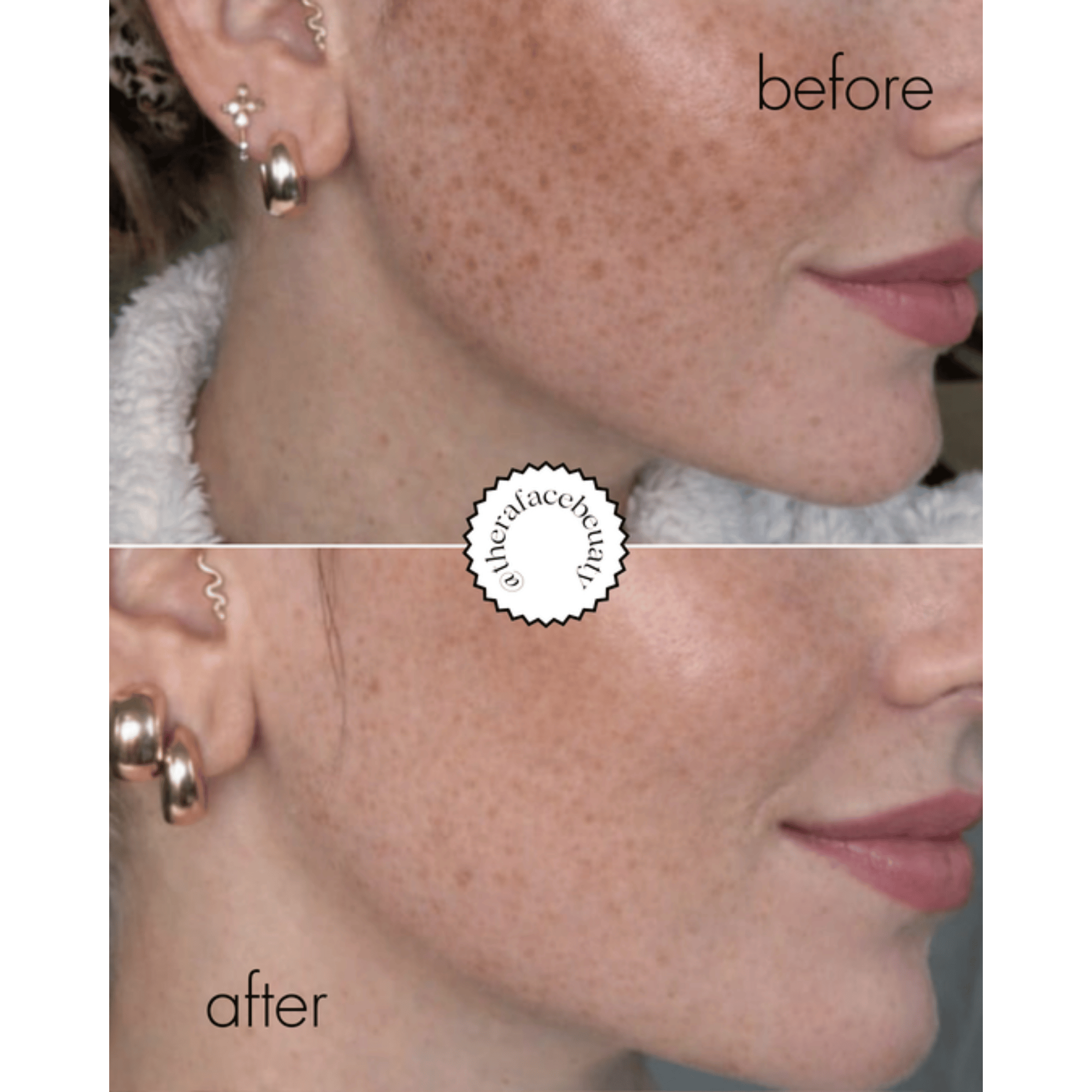Before and after comparison of a woman's face with skin treatment results, featuring the brand 'afterplace'.