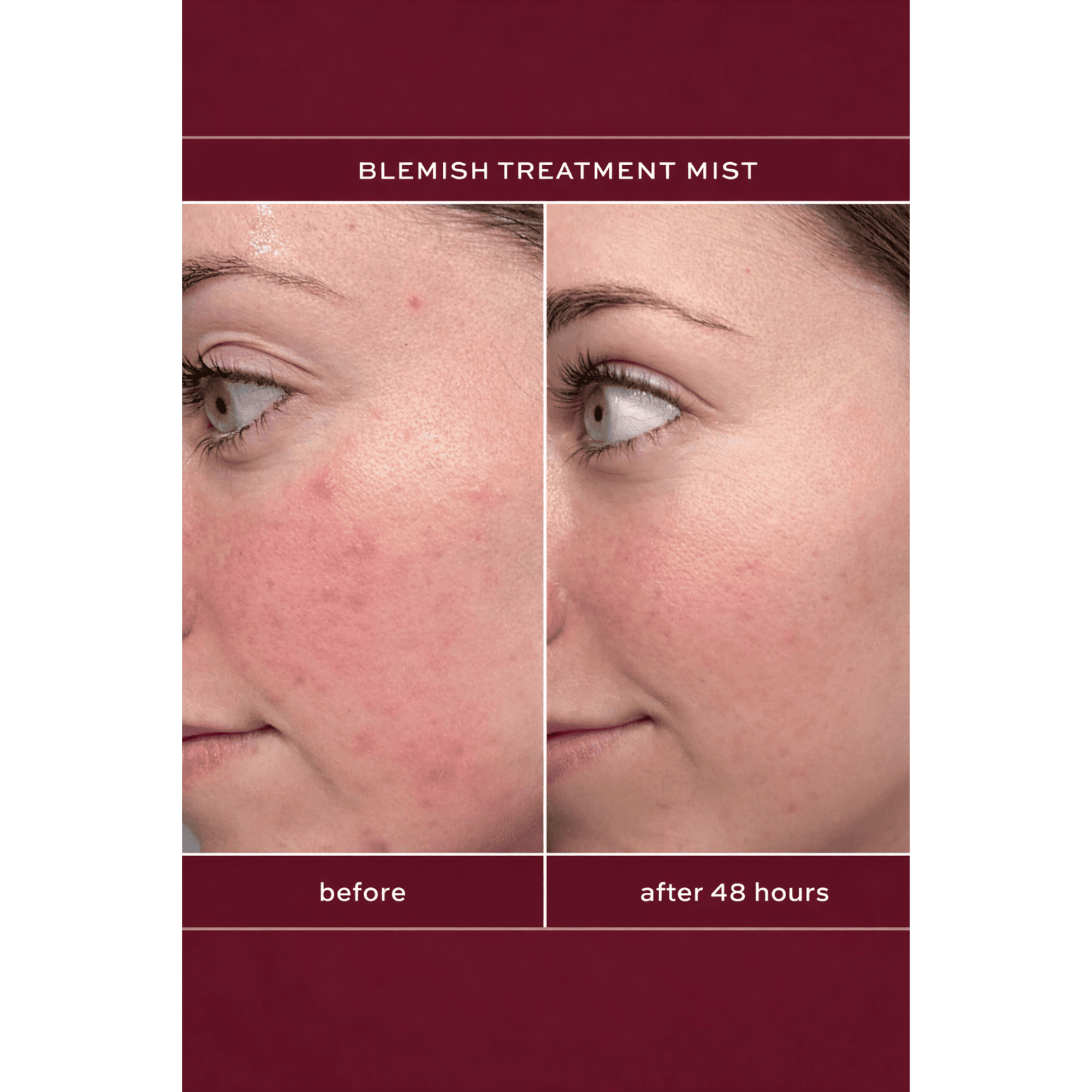 Before and after comparison of blemish treatment mist on a person's face.